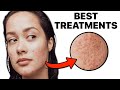 How To Get Rid of Acne Scars