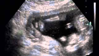 2005-01-20-ultrasound 2.avi