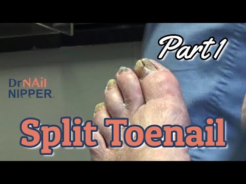 Fungal Toenails in the Podiatry Office, Part 1 (2021)