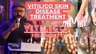 VITILIGO SKIN DISEASE TREATMENT | VITILIGO TREATMENT | LIP VITILIGO TREATMENT | LEUCODERMA TREATMENT