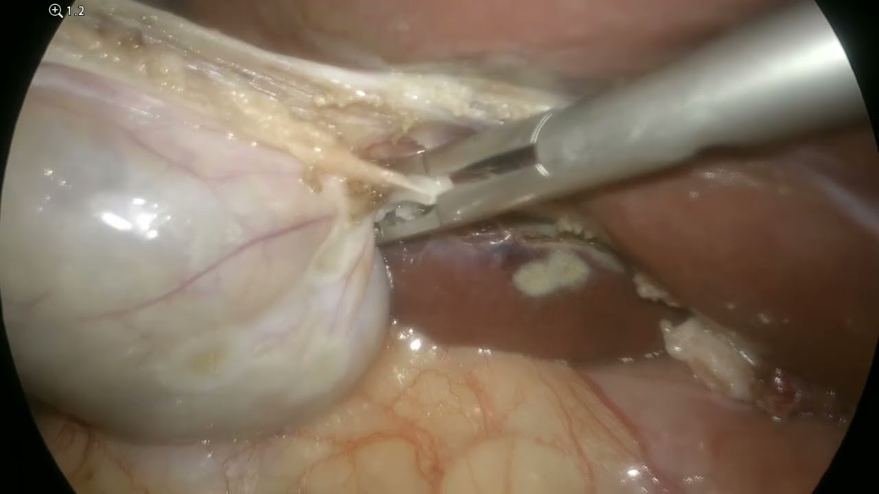 Step by Step Laparoscopic Cholecystectomy | Critical View of Safety – Dr Nattapon Passawart