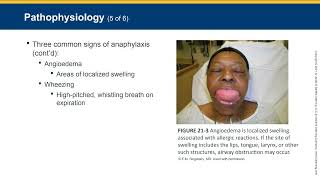 EMT Allergy and Anaphylaxis