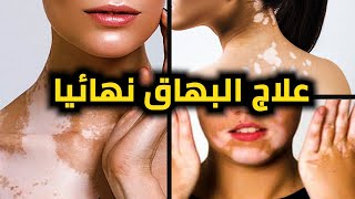 دواء طبيعي لعلاج مرض البهاق