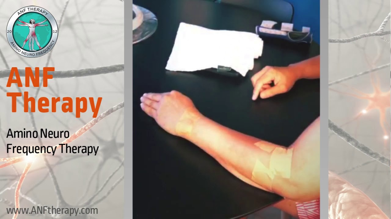 Patient with Radial Nerve Palsy ANF Therapy® YouTube