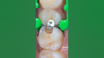 Class 2 Composite Restoration 💕