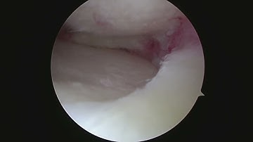 Knee Arthroscopy: Partial Medial Meniscectomy (Meniscus Surgery in a Patient with Mild Arthritis)