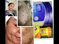 Can Carotone and Blueseal   Vaseline  treat ACNE an#let's see what it can really do#