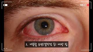 여름철 유행 질병, 이렇게 예방하세요! 장염·눈병 완벽 대처법