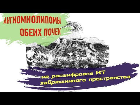 АНГИОМИОЛИПОМЫ ПОЧЕК на расшифровке КТ брюшной полости и забрюшинного пространства