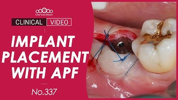 #47 Implant placement with apically positioned flap - [Dr. Cho Yongseok]