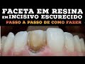 🛑FACETA EM RESINA COMPOSTA EM INCISIVO ESCURECIDO: PASSO A PASSO NA PRÁTICA ( CORES, PIGMENTOS...)🎯🤫