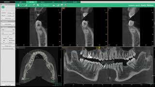 Vatech [Ez3D-i] - SECTION Tab 02 : Vue de la section et manipulation des courbes