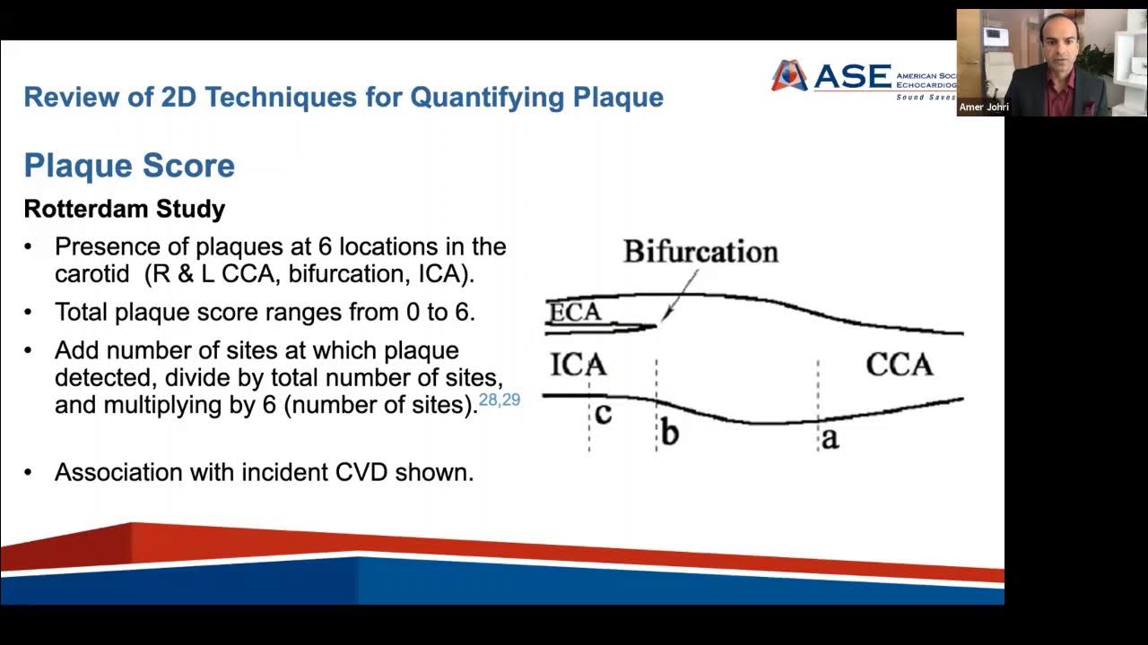Carotid Arterial Plaque by Ultrasound Characterization of