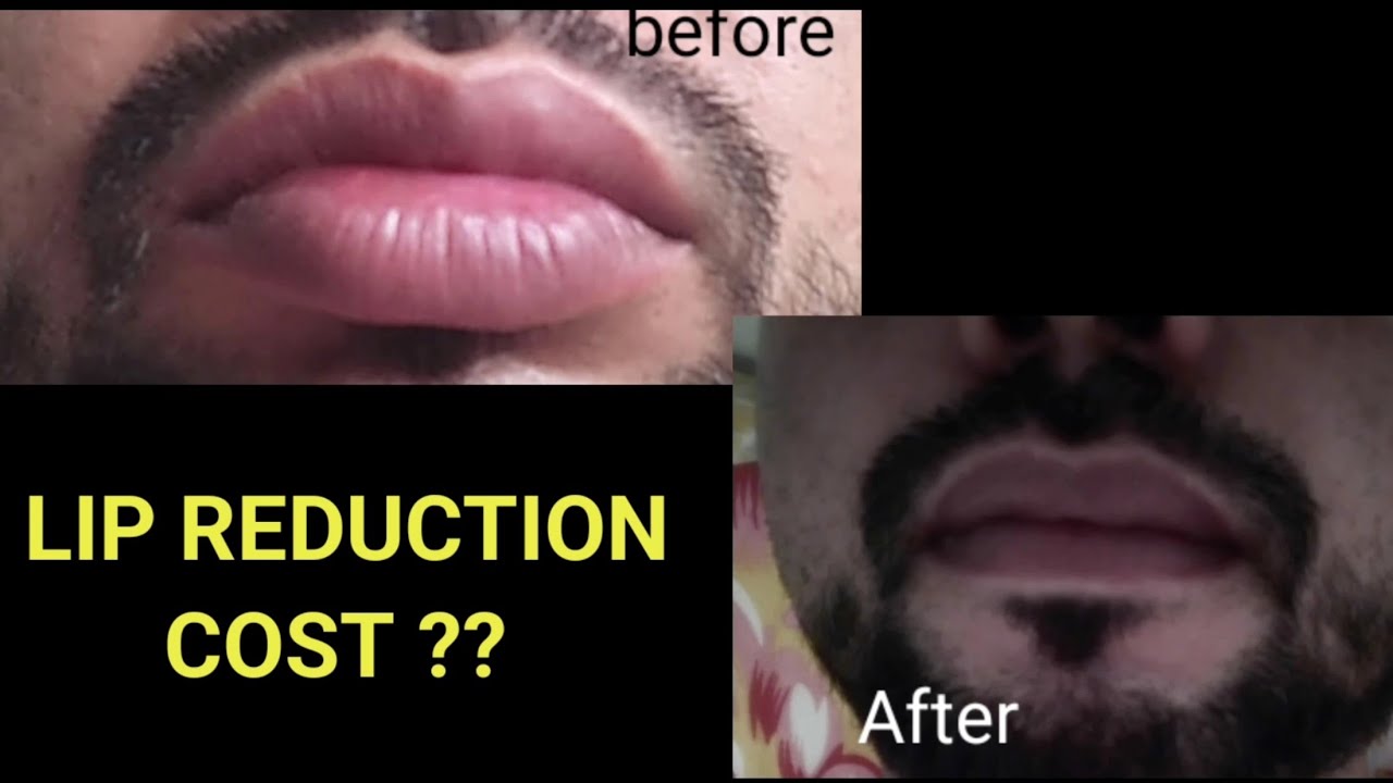 LIP REDUCTION COST INDIA hyderabad jaipur ahmedabad udaipur kanpur
