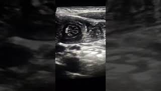 Intussusception