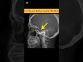 "WORM IN THE EYE?! 😳 Real X-ray Will Shock You!"#RadiologyShorts #EyeWorm #MedicalShorts #CTScan #Dr