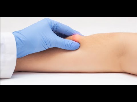 Как выглядит липома на ноге Giant Lipoma Over Thigh - YouTube