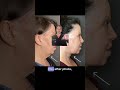 Should You Get a Necklift + Facelift Combo?