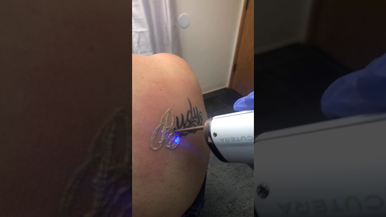 Worlds premier Laser Tattoo Removal "Enlighten" by Cutera
