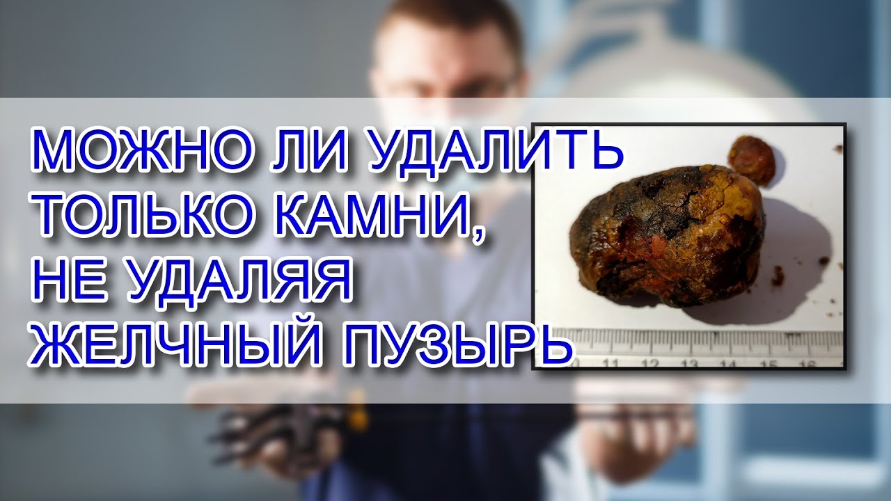 Можно ли УДАЛИТЬ ТОЛЬКО КАМНИ, не УДАЛЯЯ ЖЕЛЧНЫЙ ПУЗЫРЬ - YouTube