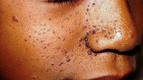 Tuberous sclerosis Symptoms – Causes Treatment Signs and Symptoms of Tuberous sclerosis