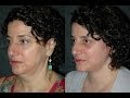 Facelift Surgery Before and After by Top NYC Plastic Surgeon #bestfaceliftsurgeon