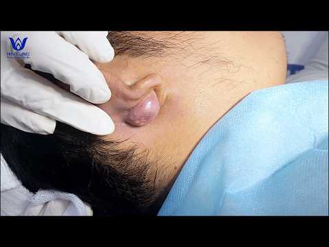 Tổng hợp nặn những ca mụn sưng viêm, nhiều dịch mủ trắng.