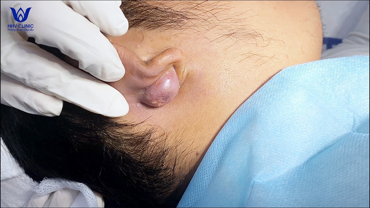 Tổng hợp nặn những ca mụn sưng viêm, nhiều dịch mủ trắng.