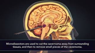Medical Animation of Brain Tumor Removal