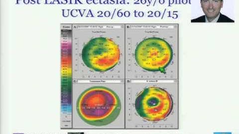 Long term follow-up of the Athens Protocol  in 212 Keratoconus eyes