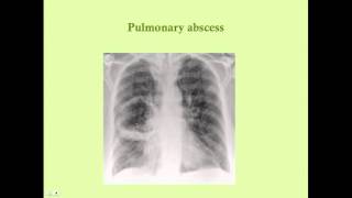 Pulmonary Infections - CRASH! Medical Review Series