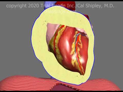 Pericardiocentesis in Pericardial Effusion and Cardiac Tamponade Animation by Cal Shipley, M.D.