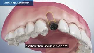 Lateral Ridge Augmentation Explained | Bone Grafting for Dental Implants