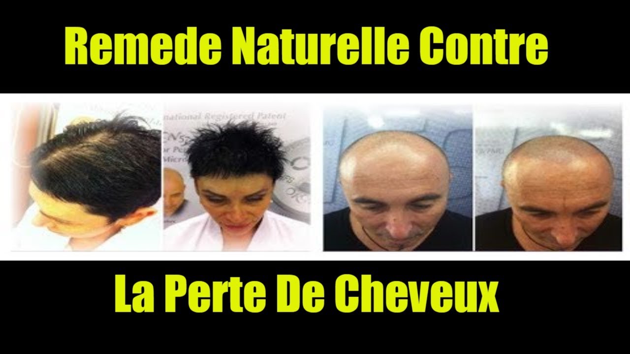 Remede Calvitie - Recette Naturelle Contre La Perte De Cheveux et Avoir