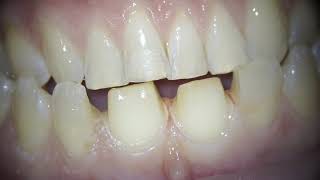 Препарирование зубов под керамические виниры #стоматология #виниры #имплант #пломба #стоматолог