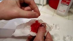 How To Drain A Smashed Fingernail Toenail & Clean It