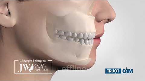 Khác biệt phẫu thuật trượt cằm và độn cằm là gì?