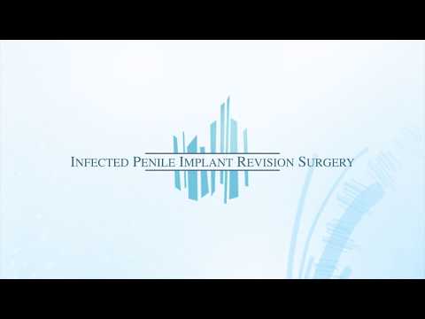Infected Penile Implant Revision Operation by Dr Hakky in Atlanta