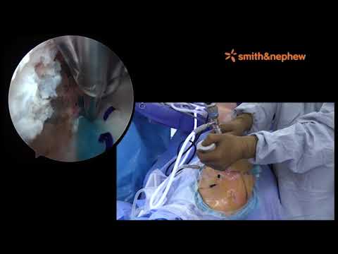 Full Thickness Rotator Cuff Repair using REGENETEN Bioinductive Implant with Dr.Trenhaile