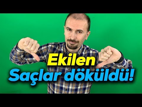 Ekilen saçlar döküldü! | 7. hafta geride kaldı PRP yaptırdım