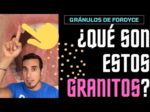 Video: Este angiokeratomul de Fordyce contagios?