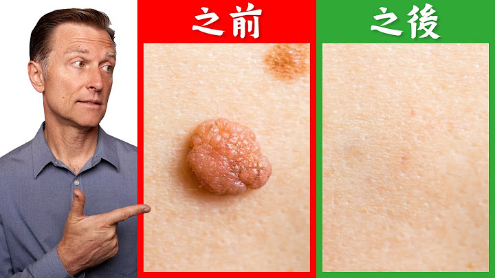 快速移除皮膚瘜肉,肉疣,皮贅自然療法柏格醫生 Dr Berg - 天天要聞