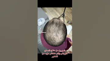 شهرين من علاج الصلع الوراثي Shorts Dermatologist الصلع الوراثي الصلع Drwael Mansour 