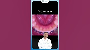 Kéo Răng Mọc Ngầm Khi Chỉnh Nha | Bác Sĩ Yên