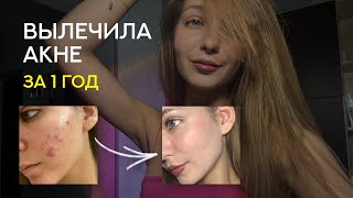 как я вылечила акне за 1 год