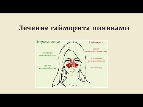 Лечение гайморита с помощью пиявок