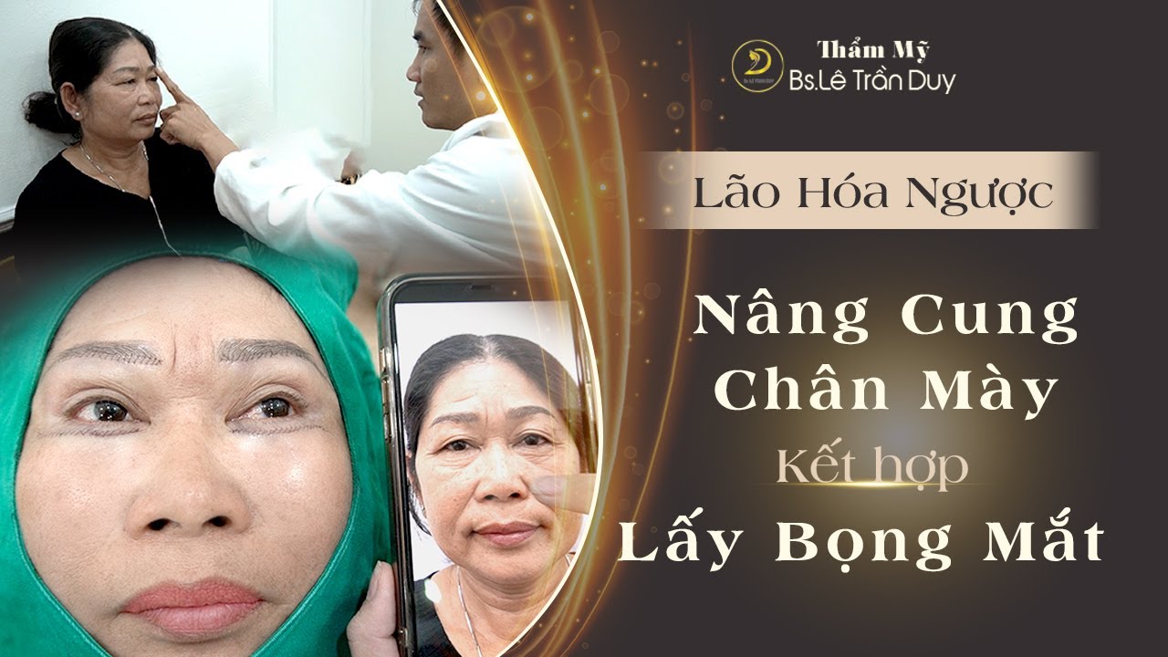 Treo chân mày - lấy bọng mắt đẹp ở Tp.HCM | Thẩm mỹ mắt an toàn