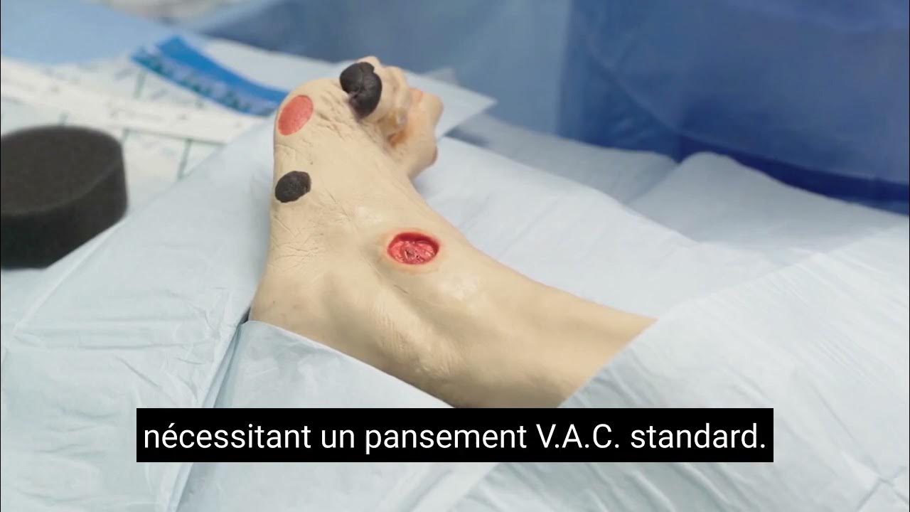 VAC Dressing Foot Wound Bridging Technique / Pansement VAC Technique de