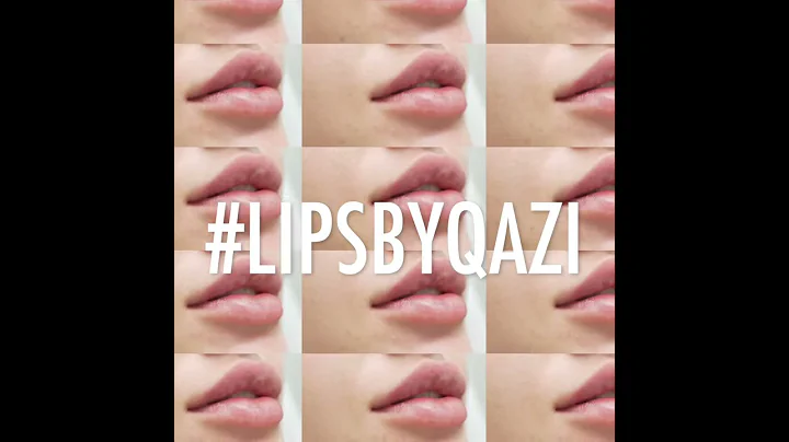 Amazing BEFORE & AFTER Lip Filler RESULTS! 💋