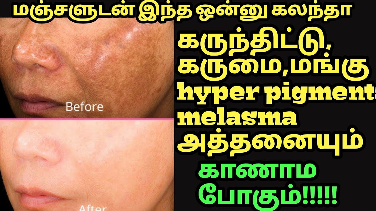 2 பொருள் கருந்திட்டு,மங்கு, melasma எதுவாயிருந்தாலும் சரிசெய்யும்
